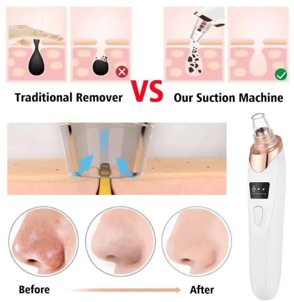 Blackhead Remover