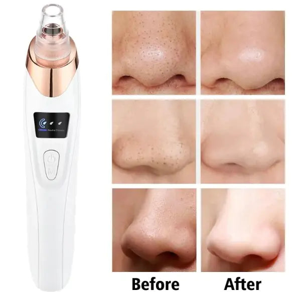 Blackhead Remover